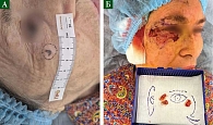 Рис. 7. Удаление образования подглазнично-скуловой области, семь этапов операции: А – предполагаемые границы образования до операционного вмешательства;  Б – иссечение образования, седьмой этап