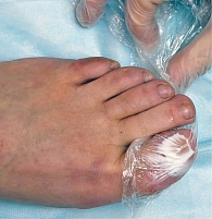 Рис. 3. Аппликация крема ЭМЛА (лидокаин + прилокаин) с экспозицией 60 минут