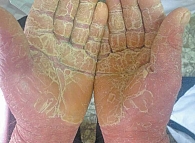 Рис. 8. Пациент Р., 58 лет, диагноз «псориатическая эритродермия, кератодермия ладоней»