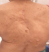 Рис. 4. Деформация позвоночника (фото из личного архива А.Г. Пашинян)