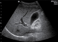 Рис. 3. Данные трансабдоминального УЗ-сканирования брюшной полости больной А. через шесть месяцев после консервативной терапии