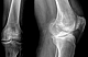 Алгоритм фармакологического лечения остеоартрита коленного сустава (рекомендации ESCEO-2016)