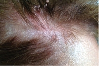 Рис. 18. Пациентка М. после двух инъекций устекинумаба.  Мелкие псориатические бляшки  на волосистой части головы