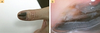 Рис. 5. Больная Ф., 62 года: подногтевая меланома (клиническое (А) и дерматоскопическое (Б) изображение)