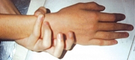 Рис. 1. Признак Мардоха – симптом долихостеномелии, свойственный синдрому Марфана (способность охватить свое запястье мизинцем и большим пальцем)