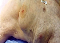 Рис. 11. Внешний вид сосудистой мальформации левой молочной железы у 16-летней девочки