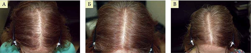Выпадают волосы 60 лет. Андрогенная алопеция Селенцин. Лосьоны для волос при андрогенной алопеции у женщин. Выпадают волосы после менопаузы. Стрижки при алопеции у женщин после 40.