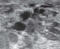 Рис. 12. Эхограмма сосудистой мальформации левой молочной железы у 16-летней девочки