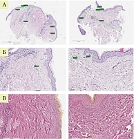 Рис. 9. Гистологическая картина у пациентки Ш. до и после лазерной терапии (А, Б – ГЭ, В – В-Г)