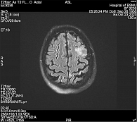 Рис. 7. Зоны измененного сигнала в режиме Т2 МРТ головного мозга в левом полушарии головного мозга у пациентки Д., 67 лет, с острым ишемическим инсультом, острый период
