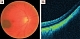 Спектральная оптическая когерентная томография в режиме enhanced depth imaging в диагностике начальных новообразований хориоидеи