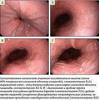 Рис. 1. Эндофотоснимок пищевода: А – дистальная треть пищевода