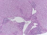 Рис. 1. Портальный и перипортальный гепатит аутоиммунной этиологии. Увеличение × 120