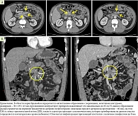 Рис. 1. Мультиспиральная компьютерная томография органов брюшной полости с контрастным усилением: А – аксиальная проекция, Б – сагиттальная проекция