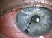 Собственный опыт применения глазных капель Офтаквикс  для профилактики послеоперационных инфекционных осложнений после лечения внутриглазных опухолей