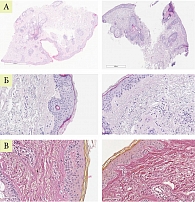 Рис. 11. Гистологическая картина у пациентки А.  до и после лазерной терапии (А, Б – ГЭ, В – В-Г)