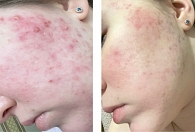 Рис. 2. Результаты лечения acne vulgaris у пациентки 16 лет (период наблюдения – восемь недель)