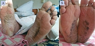Рис. 1. Пациент К. с ксерозом кожных покровов (А – исходно, Б – через 14 дней терапии)