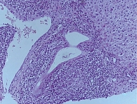 Рис. 2. Деструкция желчных протоков и формирование эпителиоидноклеточных гранулем. Увеличение × 300