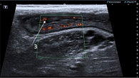 Рис. 5. УЗИ: васкуляризация стенки толстой кишки