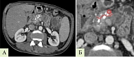Рис. 2. Пример измерения рентгеновской плотности ткани ПЖ у пациента с ХП. КТ в панкреатическую фазу: а – томограмма в аксиальной плоскости, б – увеличенный фрагмент томограммы