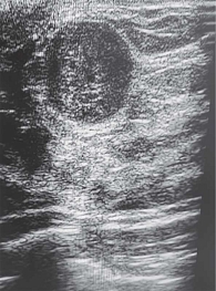 Рис. 4. Ювенильная фиброаденома левой молочной железы у 16-летней девочки