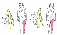 Рис. 3. Пояснично-крестцовый сколиоз при грыже межпозвонкового диска вызывает боль в ноге: а – пациент наклоняется в контрлатеральную сторону, чтобы облегчить давление грыжи на нерв; б – пациент наклоняется к той же стороне, чтобы облегчить натяжение нерв