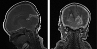 МРТ от 28 декабря 2023 г.: отек головного мозга с вклинением на уровне краниовертебрального перехода. Внутрижелудочковое кровоизлияние 3-й степени. Субарахноидальное кровоизлияние