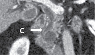 Рис. 4. МСКТ с внутривенным контрастированием (С – компрессия дистального отдела холедоха с формированием внепеченочной билиарной гипертензии)