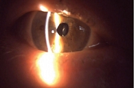 Рис. 3. Фокальная биомикроскопия правого глаза