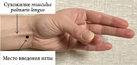 Рис. 1. Методика определения сухожилия musculus palmaris longus