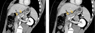 Рис. 6. Пациент М., 20 лет. Компьютерная томография органов брюшной полости: искривленная сагиттальная плоскость, венозная фаза. Способ реконструкции average, 4 мм