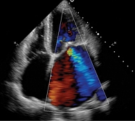 Рис. 1. Эхокардиография: выраженная недостаточность митрального клапана на момент поступления