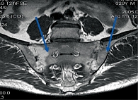 Рис. 3. Признаки двустороннего сакроилиита у пациента с анкилозирующим спондилитом (отмечено стрелками) по результатам магнитно-резонансной томографии крестцово-подвздошных сочленений в режиме STIR с жироподавлением