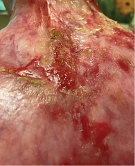 Рис. 9. Очаг плоскоклеточного рака кожи верхней трети спины