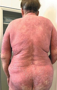 Рис. 2. Состояние при поступлении пациентки С., 71 год, диагноз «псориатическая эритродермия и псориатический артрит»