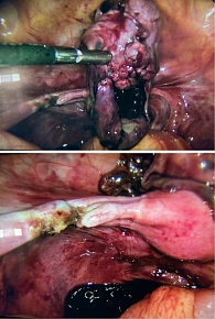 Рис. 4. Пациентка А., 11 лет: интраоперационная картина после аднексэктомии слева