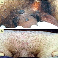 Рис. 2. Пациент с остроконечными и папуловидными кондиломами до (А) и через четыре месяца комбинированной терапии (Б)