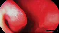 Рис. 1. Выраженная гиперемия и сухость слизистой оболочки полости носа до лечения