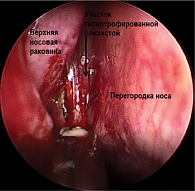 Рис. 6. Эндоскопическое фото правой половины полости носа