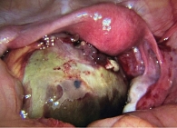 Рис. 3. Пациентка А., 11 лет: интраоперационная картина старого перекрута левых придатков матки