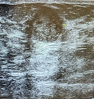 Рис. 3. Ювенильная фиброаденома правой молочной железы у 15-летней девочки