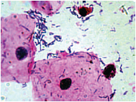 Рис. 1. «Ключевые клетки» (микроскопия мазка, окрашенного по Граму)