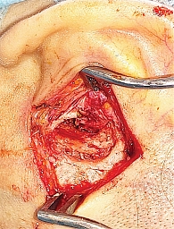 Рис. 4. Этап операции: доброкачественное новообразование удалено, костное ложе опухоли обработано