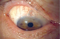 Рис. 4.  Биомикроскопия правого глаза через 14 дней после операции в диффузном освещении