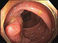 Рис. 1. Колоноскопия: опухоль прямой кишки