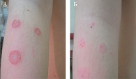 Рис. 4. Очаги микроспории на гладкой коже плеча до (А) и после (Б) лечения