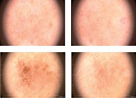 Рис. 5. Примеры дерматоскопической картины у пациентов после применения IPL-терапии (три процедуры)