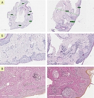 Рис. 1. Гистологическая картина у пациентки К. до и после лазерной терапии (А, Б – окрашивание ГЭ, В – окрашивание В-Г)