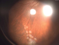 Рис. 1. Фото глазного дна левого глаза после первого этапа операции (тампонада силиконовым маслом; в верхненаружном квадранте визуализируется зона бывшего ретиношизиса, отграниченная лазеркоагулятами)